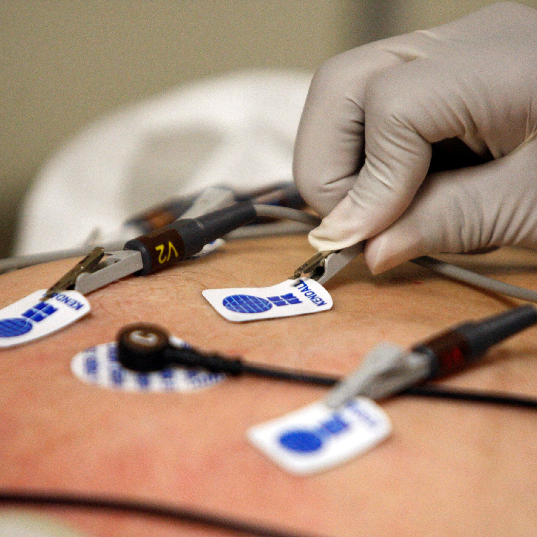 Doctors Thought It Was Asthma. A.I. Flagged a Serious Heart Problem.